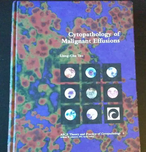 Produktbild: Cytopathology of Malignant Effusions (Ascp Theory and Practice of Cytopathology ·· 6)