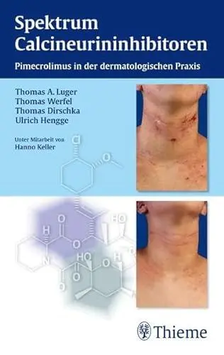 Produktbild: Spektrum Calcineurininhibitoren: Pimecrolimus in der dermatologischen Praxis