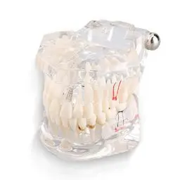 Produktbild: Yosoo transparent Erwachsenen Pathologien Dental Implant Zahnarzt Parodontalerkrankungen Demonstration ASSORT Zähne Zahnfleisch Zahnpflege Unterricht Studio Standardmodell Typodont - Abnehmbarer